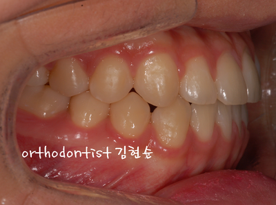 반대 교합 관련 이미지 26