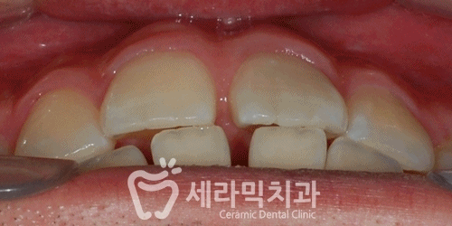 벌어진치아, 앞니벌어짐 치아교정전후 관련 이미지 3