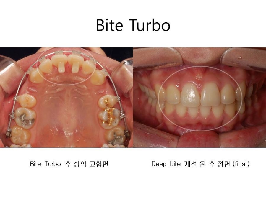 학동역치과 치아교정 잘하는 곳 ! 관련 이미지 14