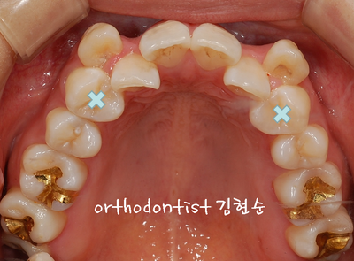 강남 덧니 관련 이미지 11