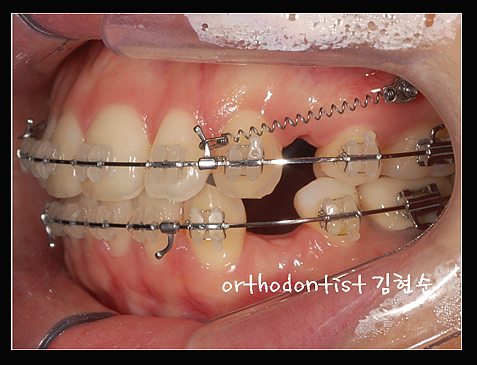 강남교정치과 관련 이미지 26