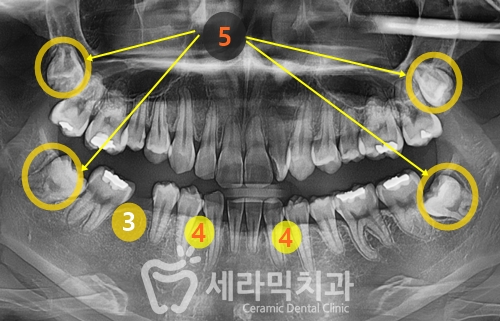 딥바이트(과개교합) 때문에 감추고 싶던 치아, 치아교정전후 달라진 미소 관련 이미지 5