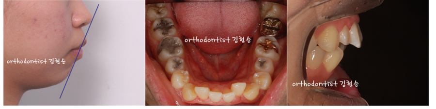 미니스크류, 돌출입 발치 교정 잇몸노출 개선 관련 이미지 6