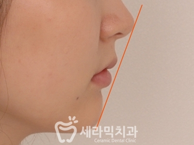 토끼이빨 돌출입 치아교정 전후 표정변화! 관련 이미지 18