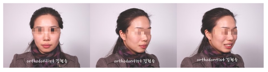 발치 돌출입교정으로 인상개선, 동안 만들기 관련 이미지 2