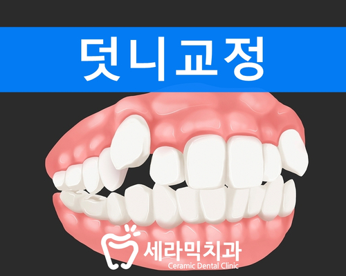 덧니 치아교정잘하는곳, 강남 세라믹치과 관련 이미지 1