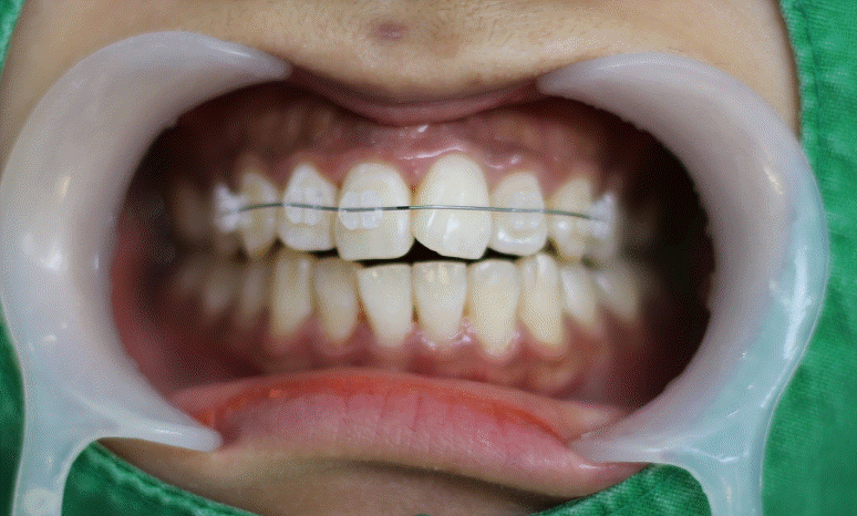 세라믹치과 3M 클래러티 어드밴스 치아교정 전속모델 콘테스트 관련 이미지 15