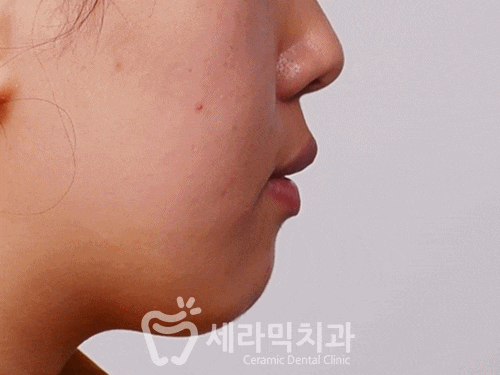 개방교합 때문에 시작한 치아교정. 돌출과 무턱까지 한번에 해결! 관련 이미지 3