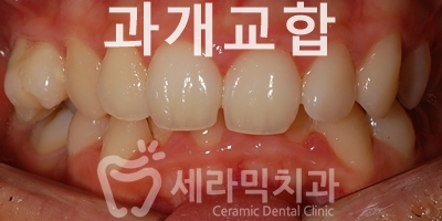 과개교합 치아교정잘하는곳, 세라믹치과 치아교정전후! 관련 이미지 2