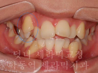 덧니교정 잘하는 학동역 교정치과, 세라믹치과 관련 이미지 3