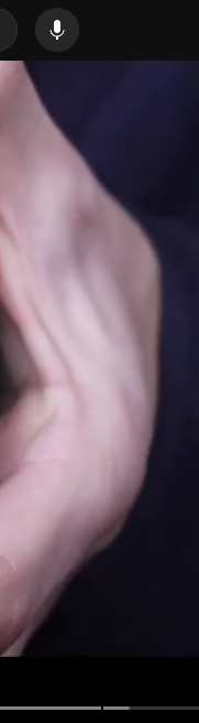 강남치아교정, 악궁확장하면 얼굴크기 커질까? 관련 이미지 12