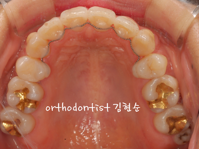 강남 덧니 관련 이미지 24
