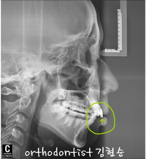 강남 돌출입 교정 관련 이미지 11