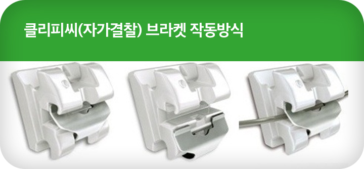 강남치아교정 브라켓비교분석 관련 이미지 6