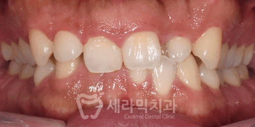A Case of Overretained Teeth and Deep Bite Orthodontics That Helped the Patient Smile Confidently Before and After image 11