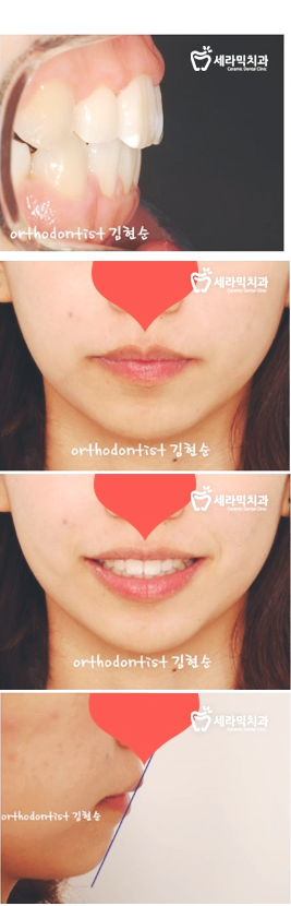 미국3M교정 어드벤스는 세라믹치과에서 ~ 관련 이미지 6