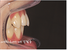강남 돌출입 교정 관련 이미지 13