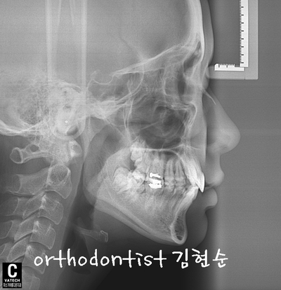 강남 돌출 (토끼 치아) 관련 이미지 13