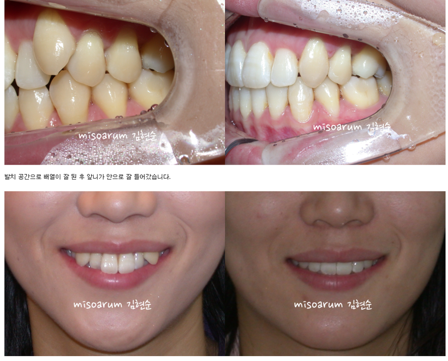 세라믹교정 덧니교정 관련 이미지 9