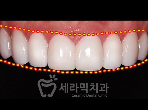 무삭제라미네이트 , 세라네이트가 궁금하다면? 관련 이미지 9