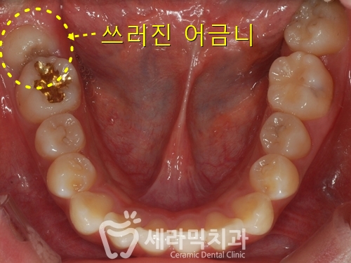 교정 전 어색한 웃음이 치아교정전후 함박웃음으로 변하게 된 사례 관련 이미지 5