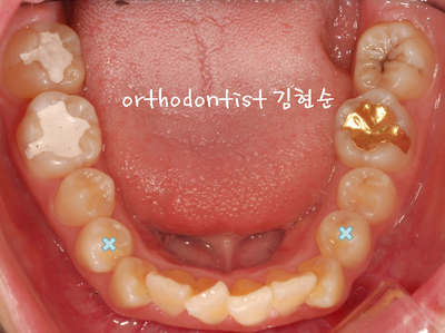 강남 돌출 (토끼 치아) 관련 이미지 15