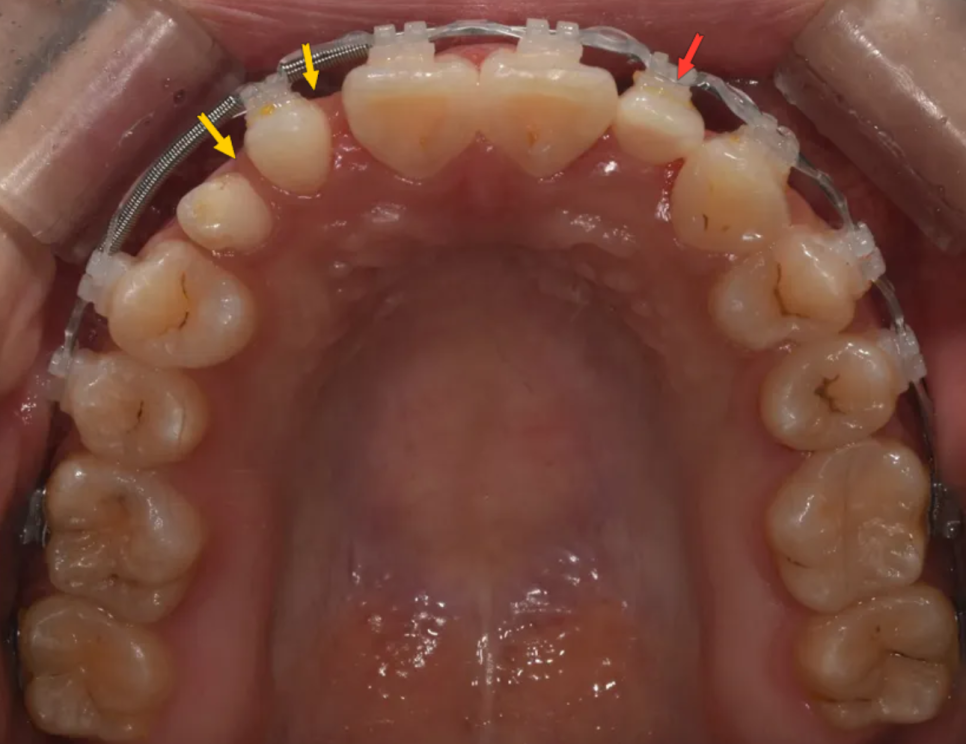 왜소치, 결손치가 동시에 있었던 환자의 앞니 심미보철 관련 이미지 9