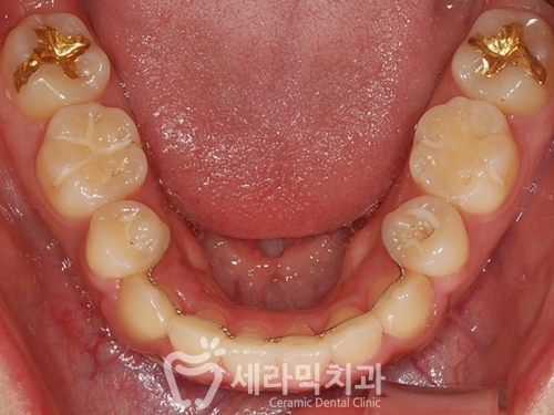 돌출입교정으로 갸름한 턱라인까지 되찾다! 돌출입 치아교정전후 관련 이미지 26