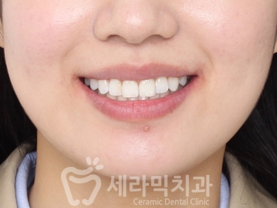 앞니 돌출, 나비치아를 남몰래 해결한 치아교정 전후! 관련 이미지 18