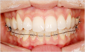 세라믹교정 세라믹치과 - 콤비네이션 교정이란 ? 관련 이미지 2