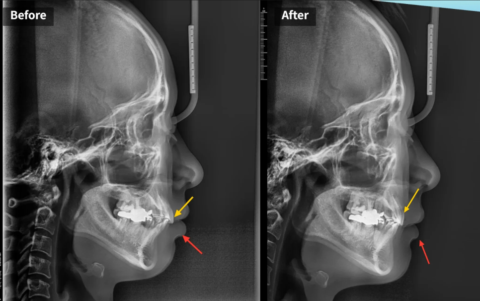 돌출입 재교정, 그것도 세 번째. 관련 이미지 11