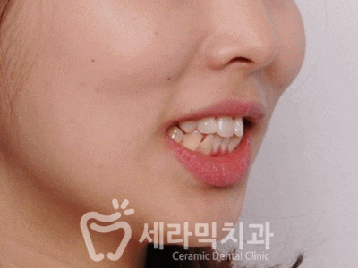 강남치아교정잘하는곳 덧니교정 전후 관련 이미지 1