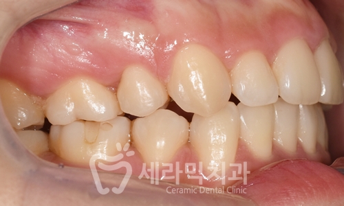 치아교정만으로 세마리 토끼를 한번에! 돌출입, 무턱, 치열불규칙 치아교정전후 관련 이미지 9