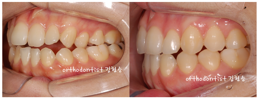 개방교합 비발치 세라믹교정 관련 이미지 12