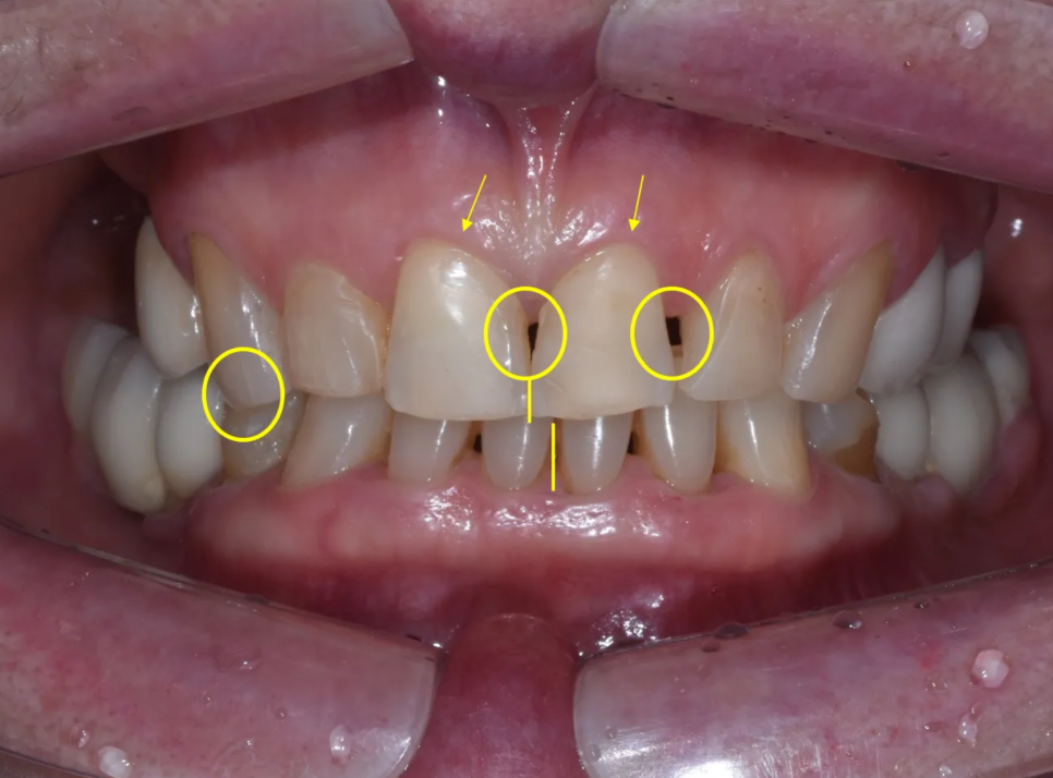강남구청역 치과, 70대 외국인 환자의 라미네이트 관련 이미지 2