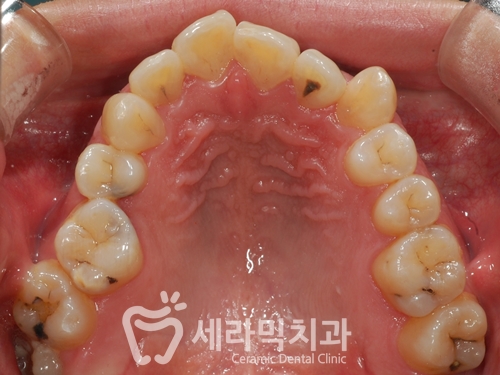 세라믹치과 치아교정전후 : 앞니반대교합+치열불규칙 관련 이미지 4