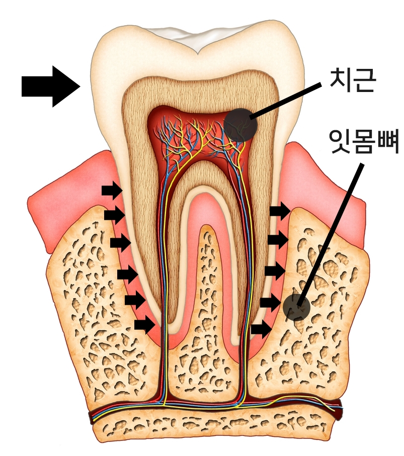 투명교정치과 투명교정의 진실 관련 이미지 4