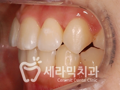 토끼이빨, 틀어진 치아배열 세라믹교정 전후사진 관련 이미지 20