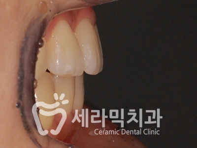 토끼이빨, 틀어진 치아배열 세라믹교정 전후사진 관련 이미지 22
