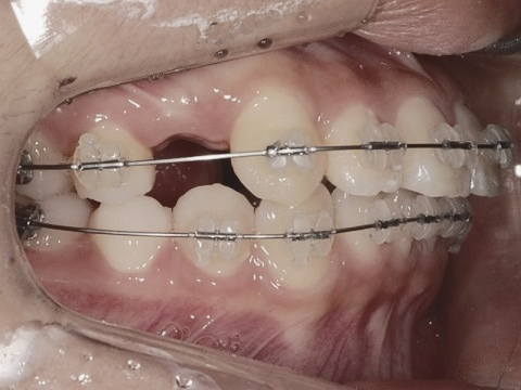 학동역치과 하면 세라믹교정 ~ 관련 이미지 19
