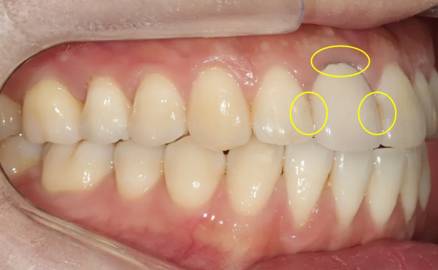 A Case of Improving the Smile Line Along with Replacing a Front Tooth Crown image 6