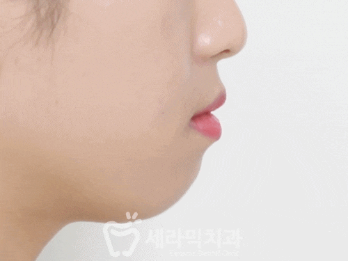 돌출입 치아교정을 통해, 매력적인 옆 라인으로 변신! 관련 이미지 3