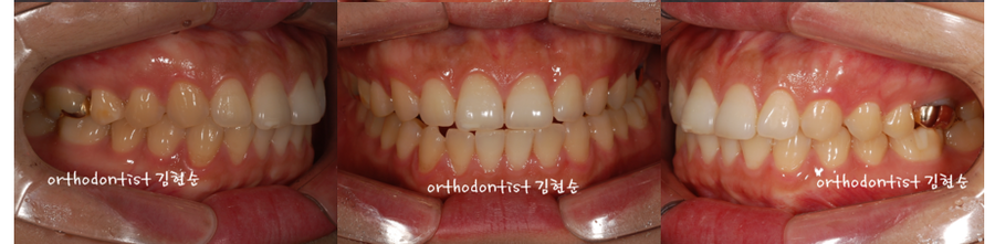 발치 돌출입교정으로 인상개선, 동안 만들기 관련 이미지 4