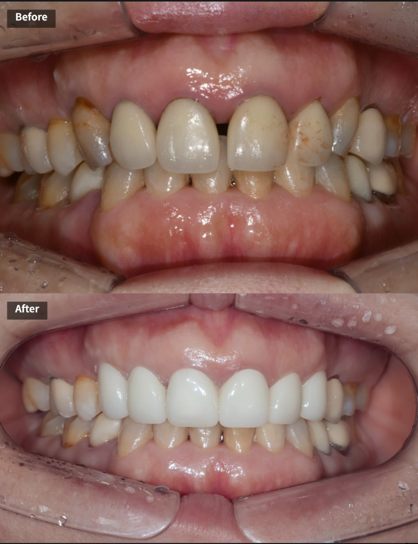 일본에서 거절당했던 앞니 심미보철 크라운 관련 이미지 13