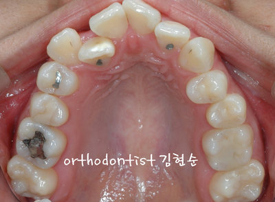 강남 돌출 관련 이미지 8