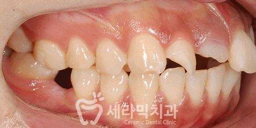 깨진 후에 후회하는 돌출입, 치아교정으로 건강하고 가지런한 치아만들기 관련 이미지 12