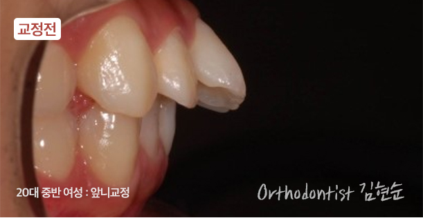 강남치아교정 브라켓비교분석 관련 이미지 17