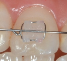 강남 교정치과 클리피씨 교정이 비싼 이유 관련 이미지 4