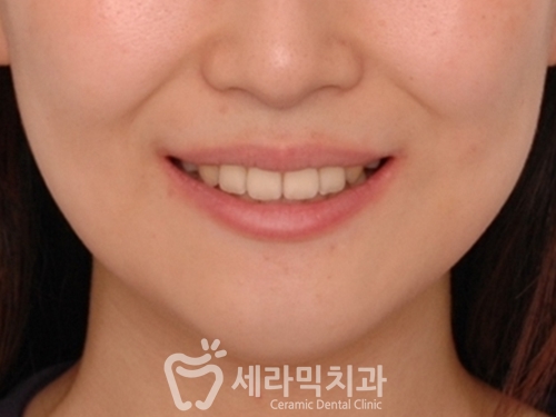 돌출입 치아교정전후. 몰라보게 달라진 얼굴변화 관련 이미지 3