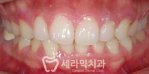 딥바이트 과개교합 치아교정전후 변화 관련 이미지 1